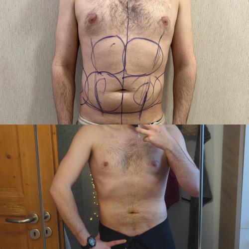 Tratamiento de ginecomastia (con liposucción) Foto antes/después